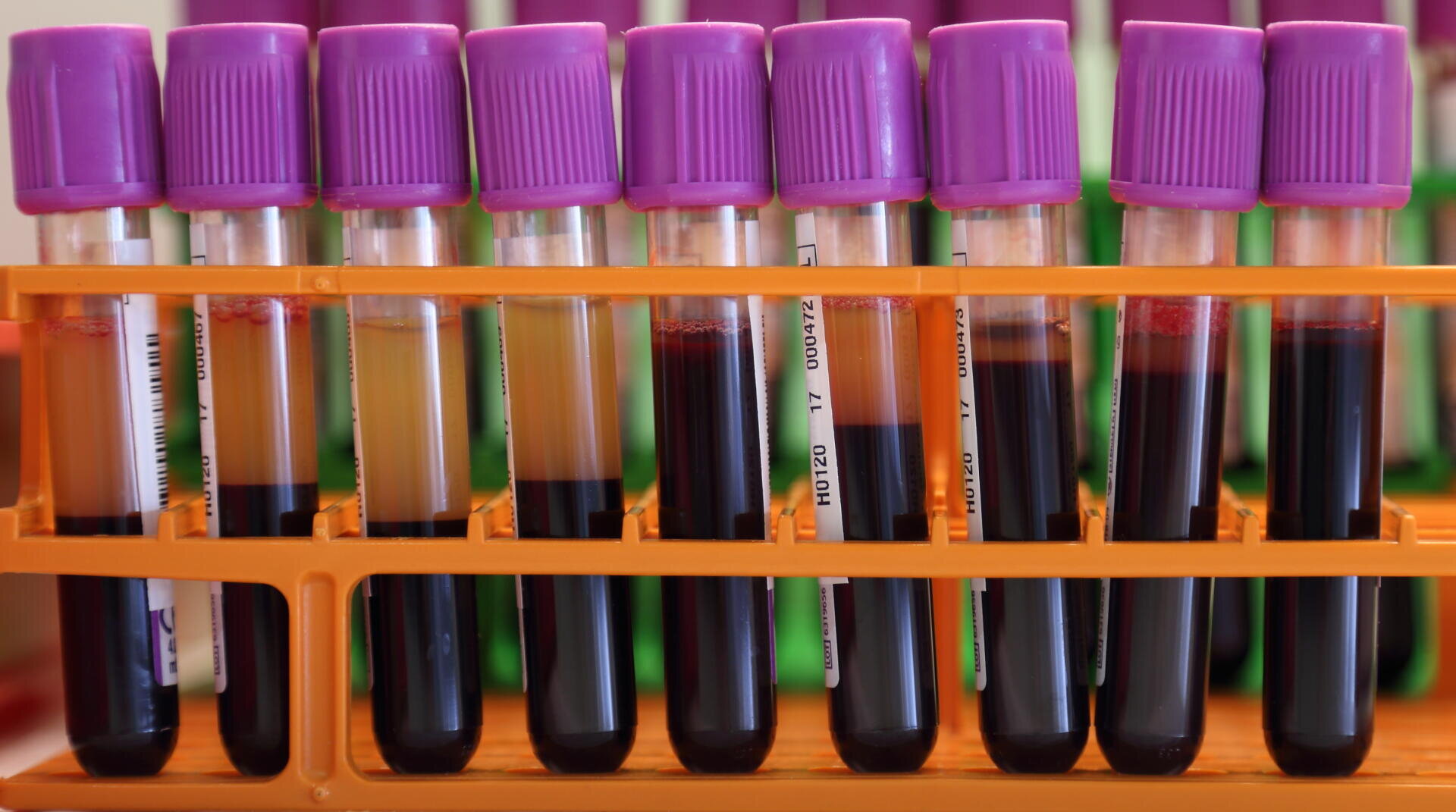 Mehrere Röhrchen mit Blut- und Plasmaproben mit violetten Kappen befinden sich in einem orangefarbenen Gestell. Die Röhrchen weisen eine unterschiedlich starke Trennung zwischen den roten und gelben Flüssigkeitskomponenten auf.